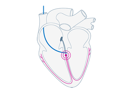 LBBAP Pacing approach depolarization pattern