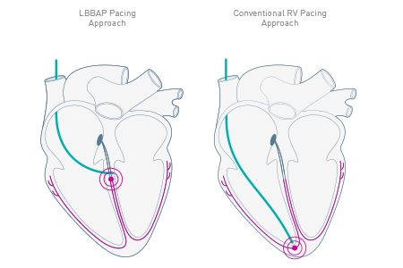 LBBAP Pacing approach depolarization pattern