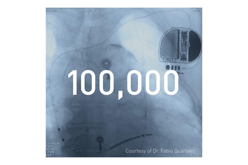 100,000 DX Devices Implanted Worldwide