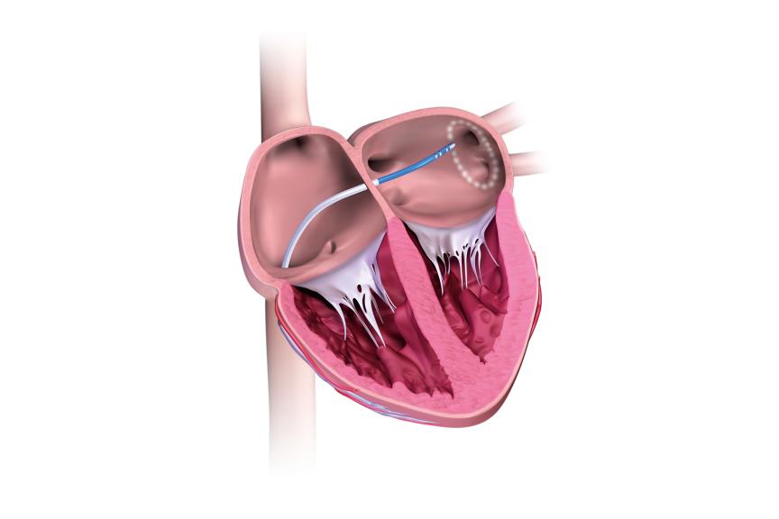 Heart illustration with catheter