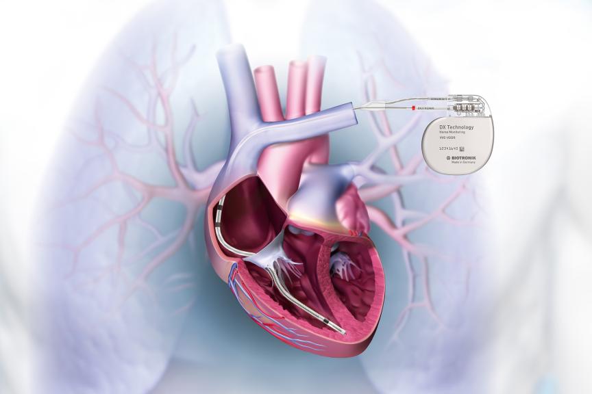 Illustration of a heart with a BIOTRONIK device