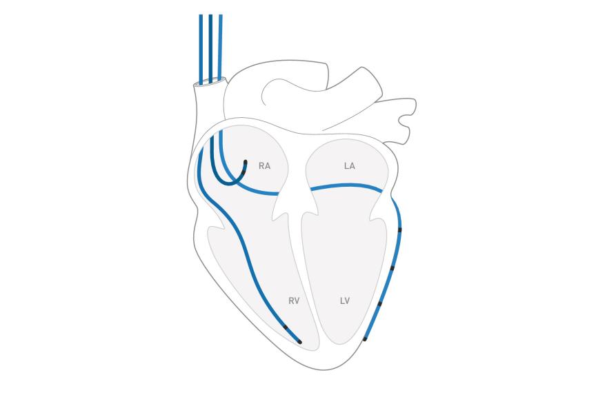 Illustration of a heart with leads