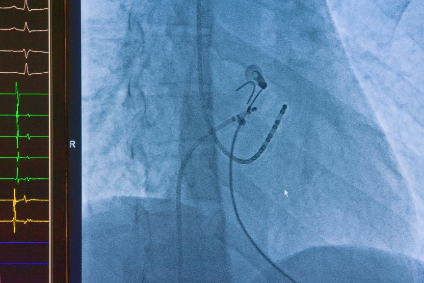 Ablation procedure