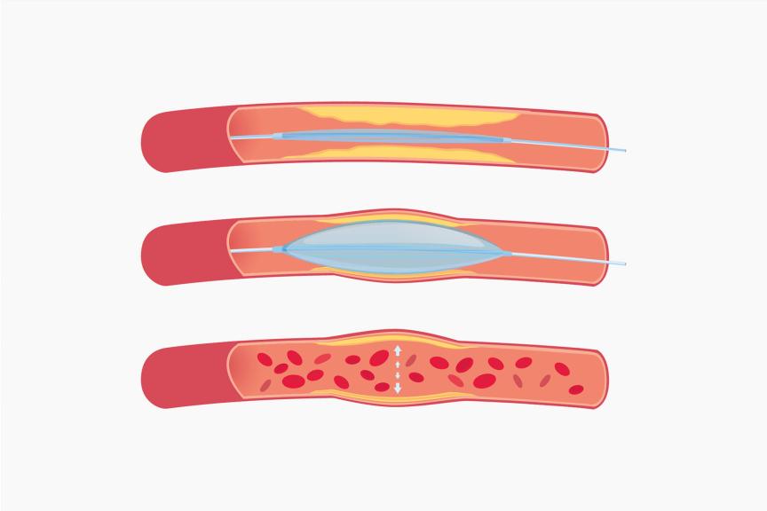 Illustration of Balloon Angioplasty