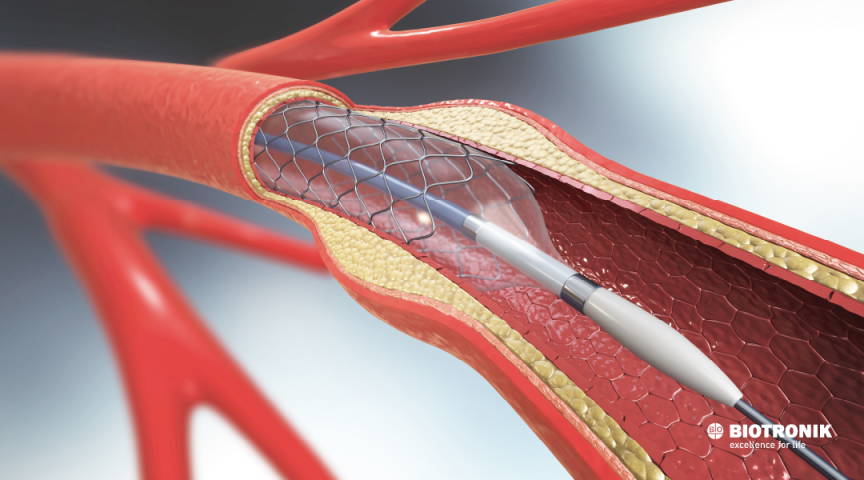 Quanto tempo dura um stent no coração?