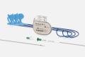 BIOTRONIK Conduction System Pacing Solution