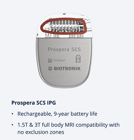 The Prospera Spinal Cord Stimulator's rechargeable Implantable Pulse Generator with a 9-year battery life.
