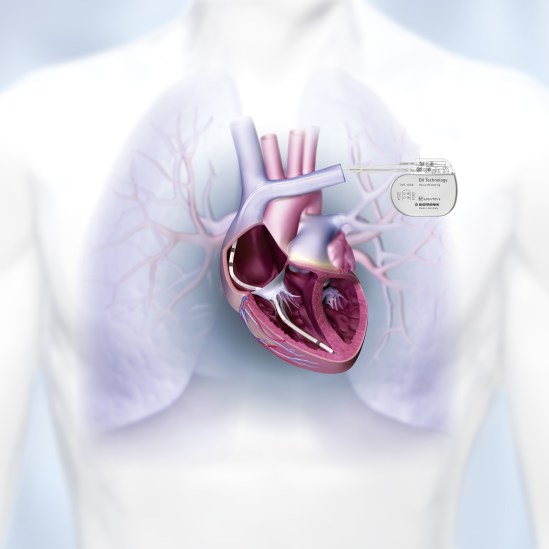 Single chamber ICD system with complete atrial diagnostics